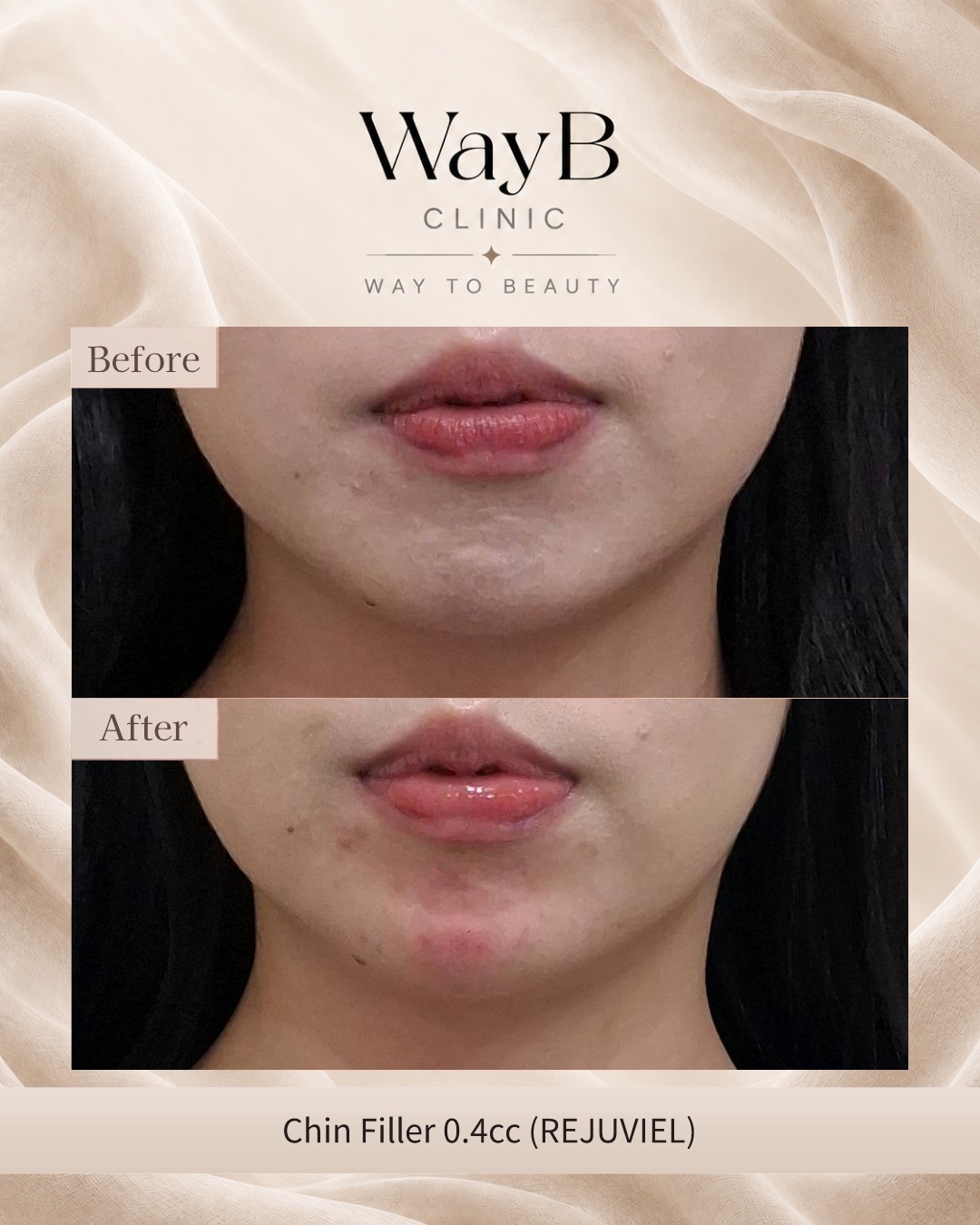 Chin Filler Case 1 Before & After