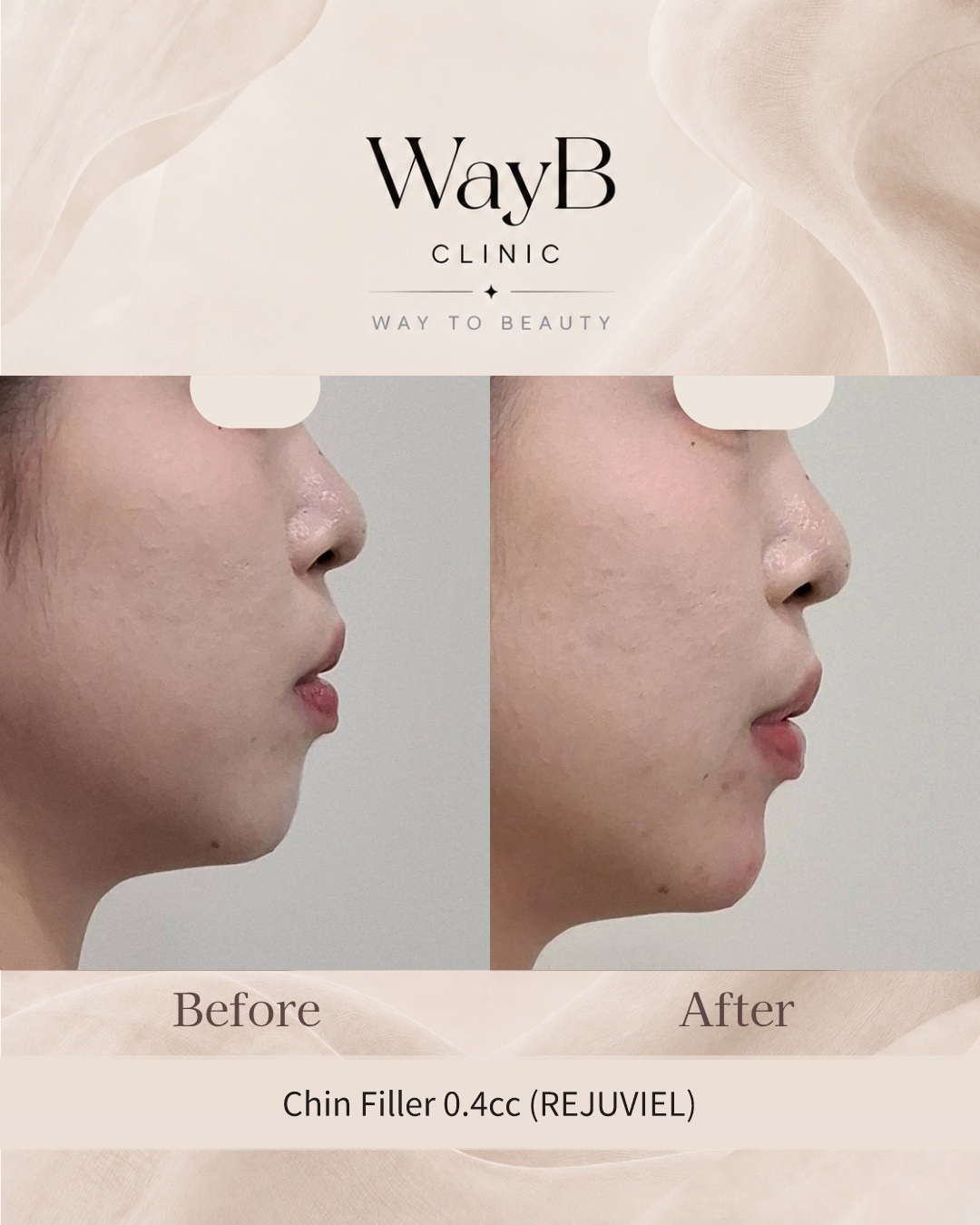 Chin Filler Case 1 Before & After
